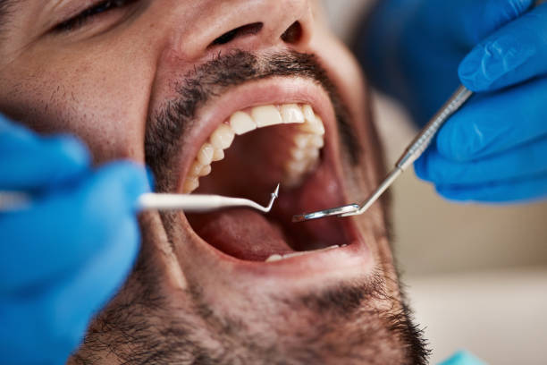 Best Emergency Dental Care for Broken or Chipped Teeth in Rome, NY